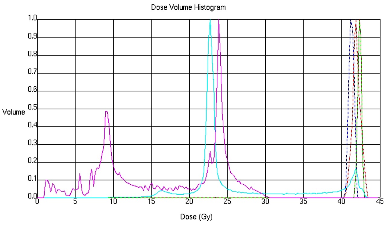 写真5:食道癌放射線照射の実際 写真5:食道癌放射線照射の実際