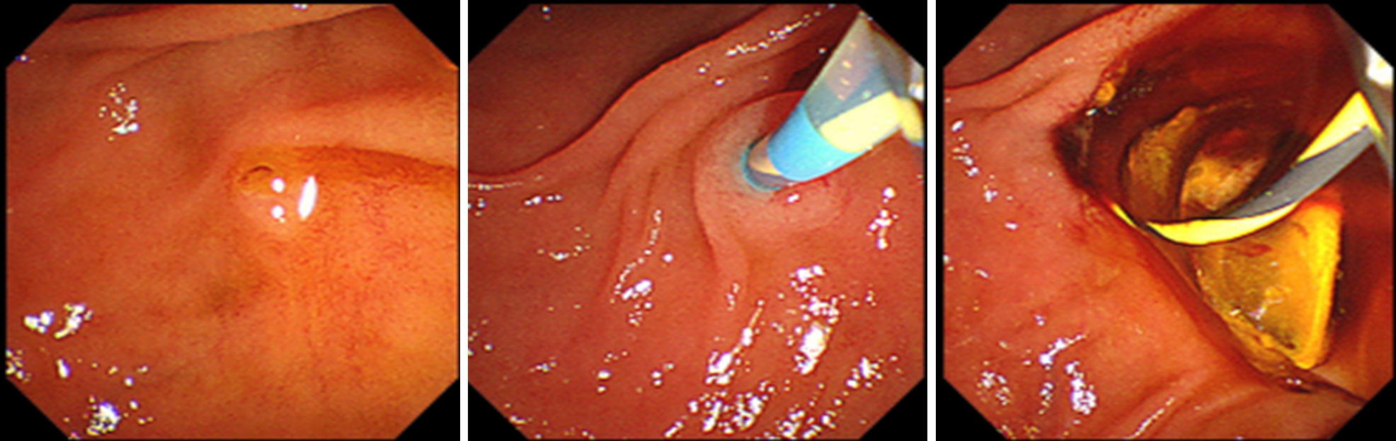 胆道・膵臓疾患