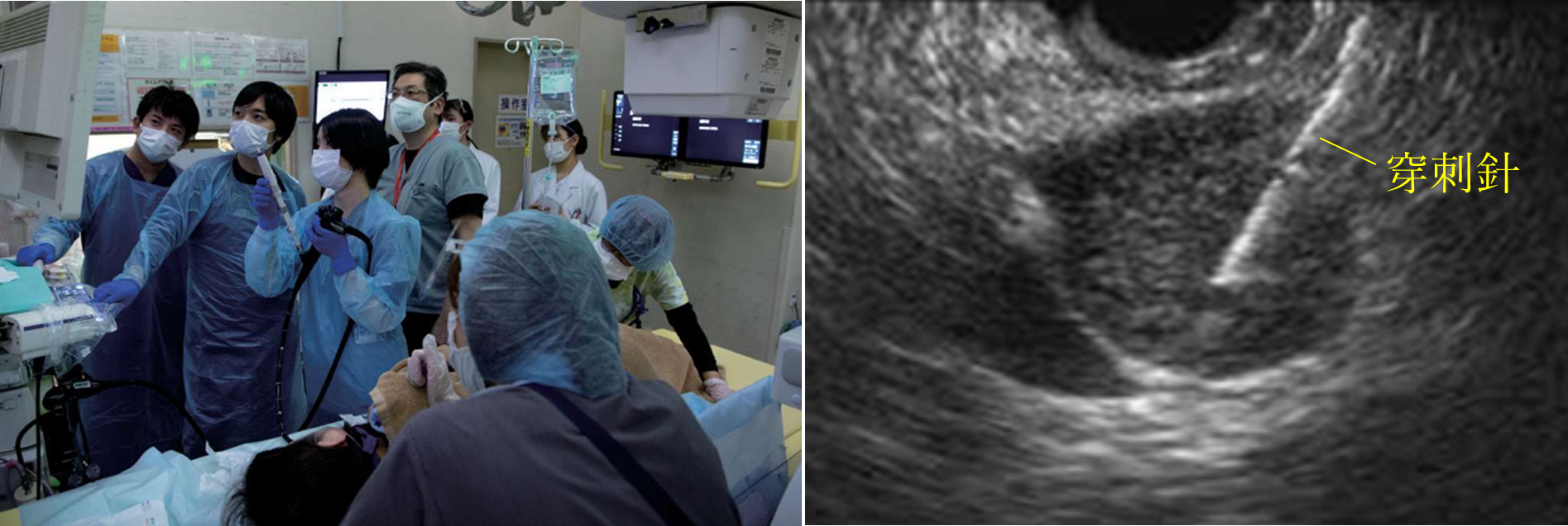 超音波内視鏡(EUS)・超音波内視鏡下穿刺吸引法(EUS-FNA)