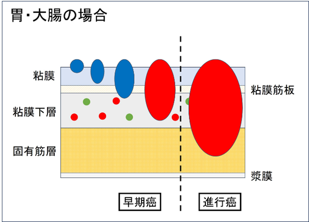 ESD胃大腸の場合