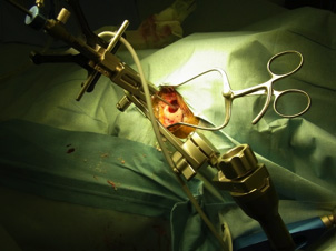 ニューロナビゲーションによる腫瘍生検術(穿頭術)